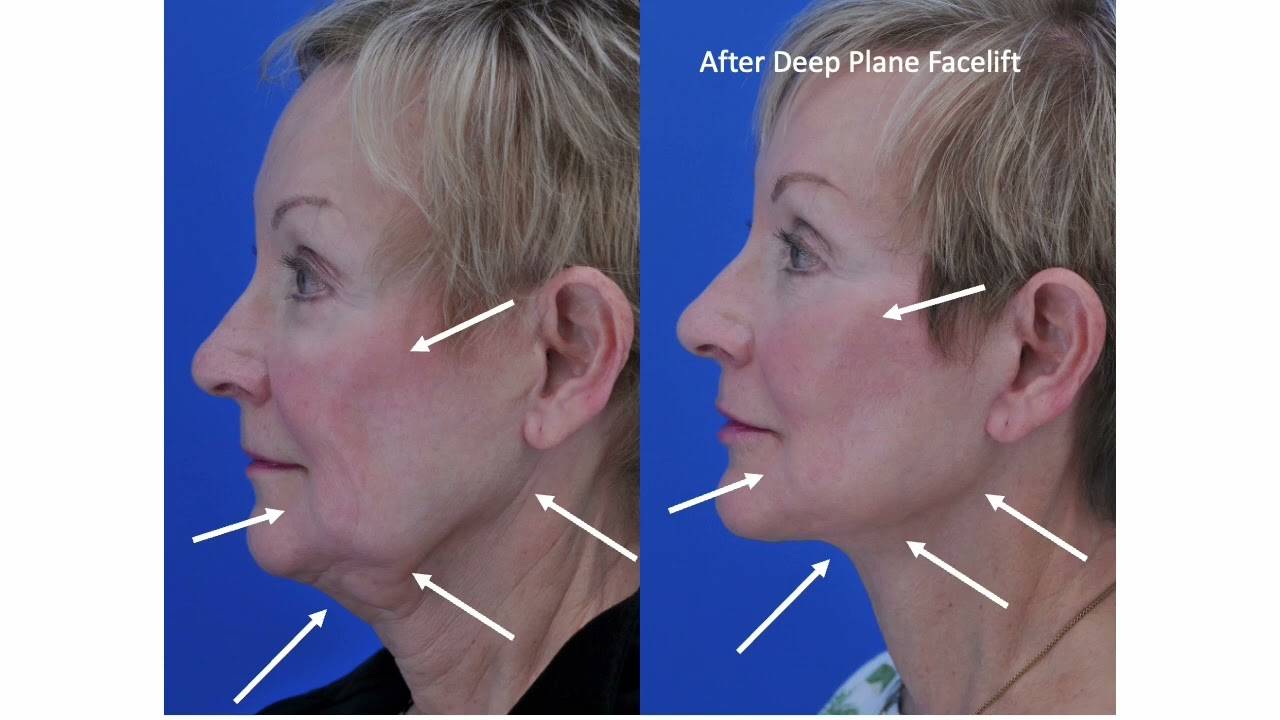 Deep Plane Facelift Surgery - Austin, TX | Free Consultations Available