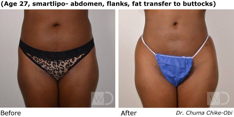 Smartlipo Flanks Liposuction for Women - Before & After Photos