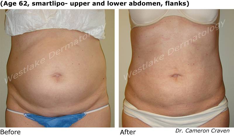 Smartlipo Before and After Photos - Westlake Dermatology & Cosmetic Surgery®