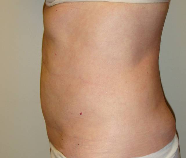 Liposuction Recovery: Tips + What To Expect