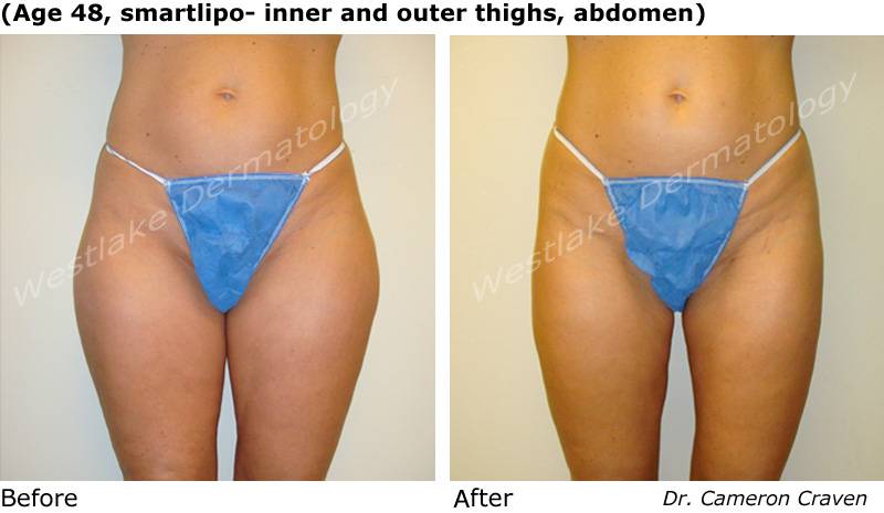 Smart Lipo Before and After Pictures Case 269, Naples and Ft. Myers, FL