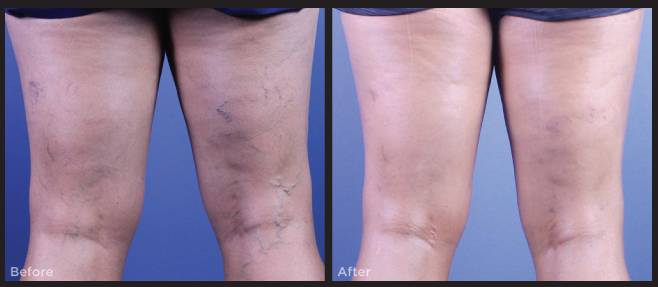 Sclerotherapy: What does it treat, cost, aftercare, and results