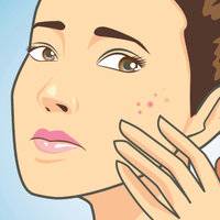 What Causes Acne Scars (And How To Get Rid Of Them)