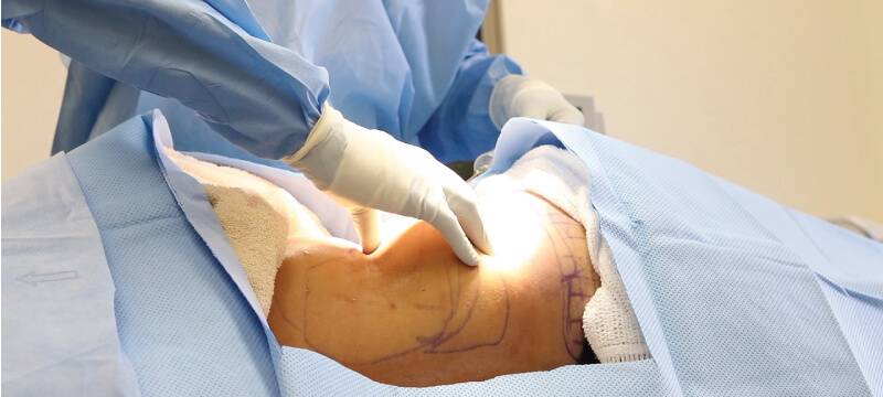 How To Reduce Swelling and Bruising After Liposuction