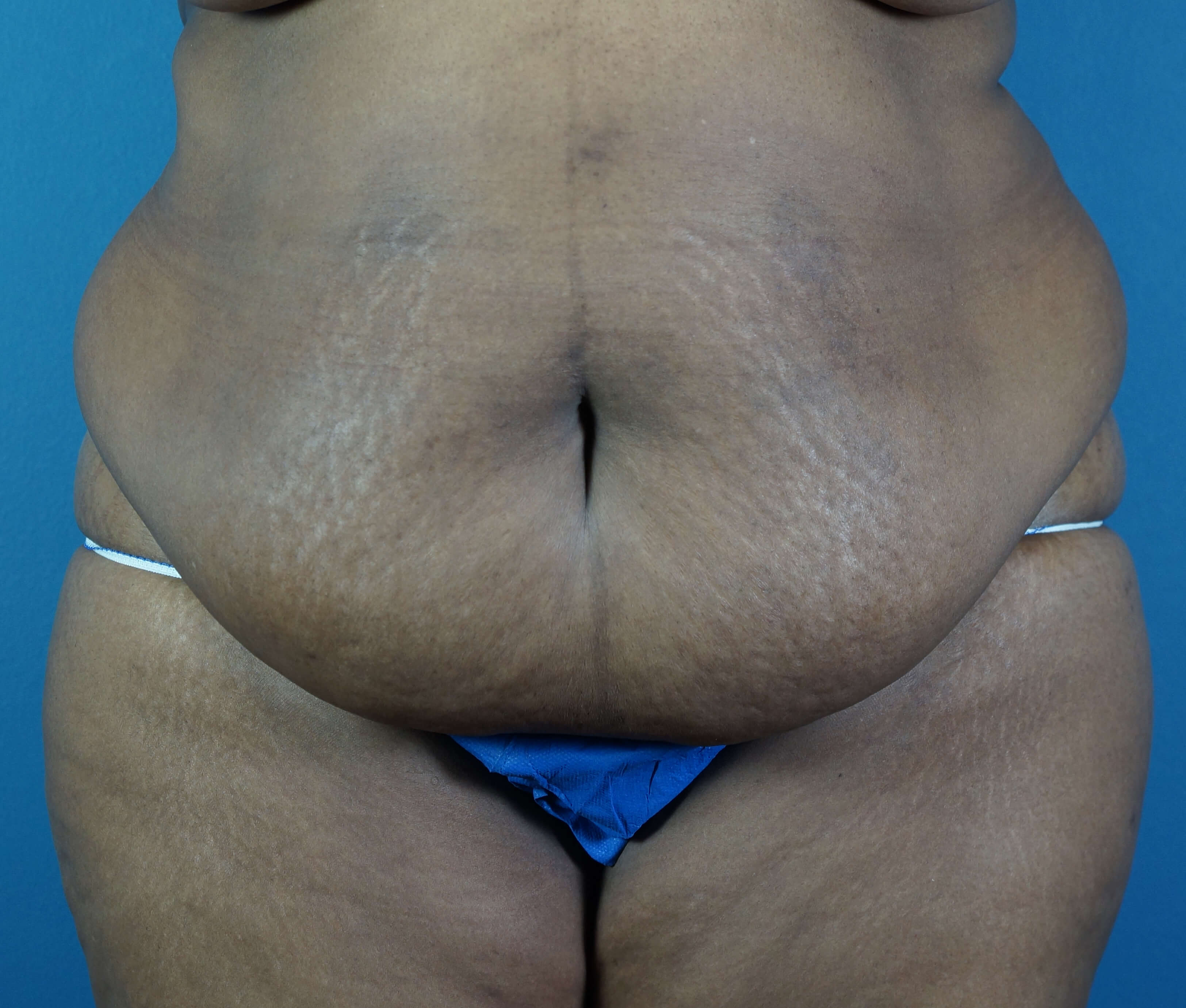 Before and After Tummy Tuck Photos - Abdominoplasty Image Gallery