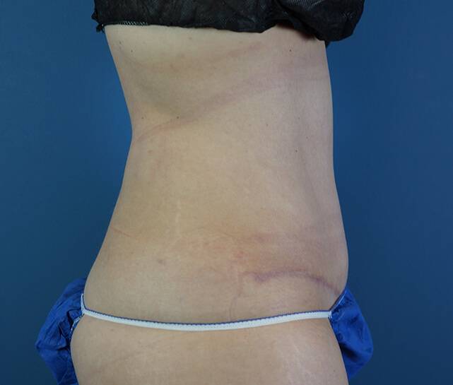 what are dog ears after tummy tuck