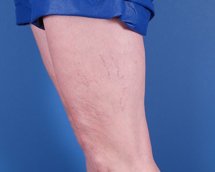 Spider & Varicose Vein Treatments & Removal - Westlake Dermatology