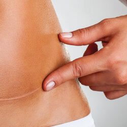 Strategies for Concealing Tummy Tuck Scars
