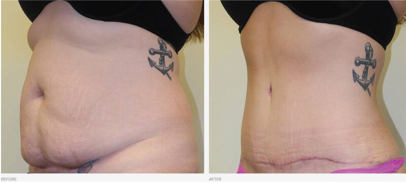 8 months post op. Hypertrophic scar after tummy tuck. What I can