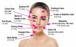 Common Botox Injection Sites: What Facial Areas Can Be Treated With ...