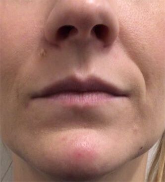 8 Different Types Of Lip Filler Shapes - Westlake Dermatology