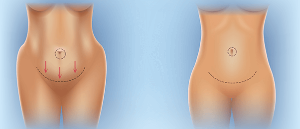 How a Tummy Tuck Can Help You See the Finish Line - Brown