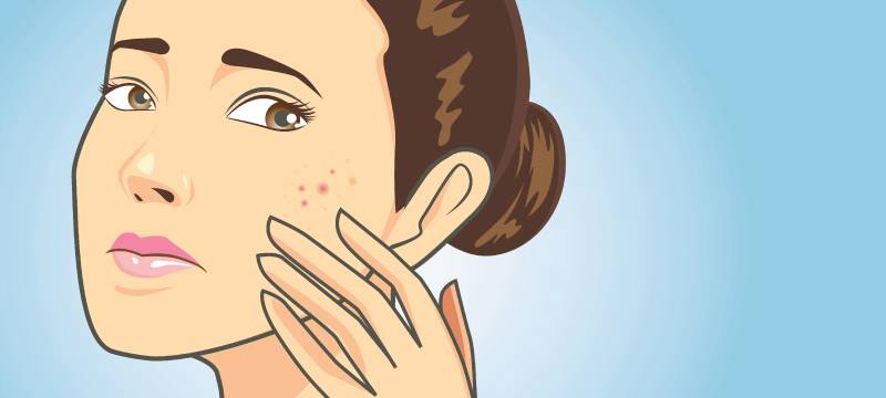 acne scarring illustratuion