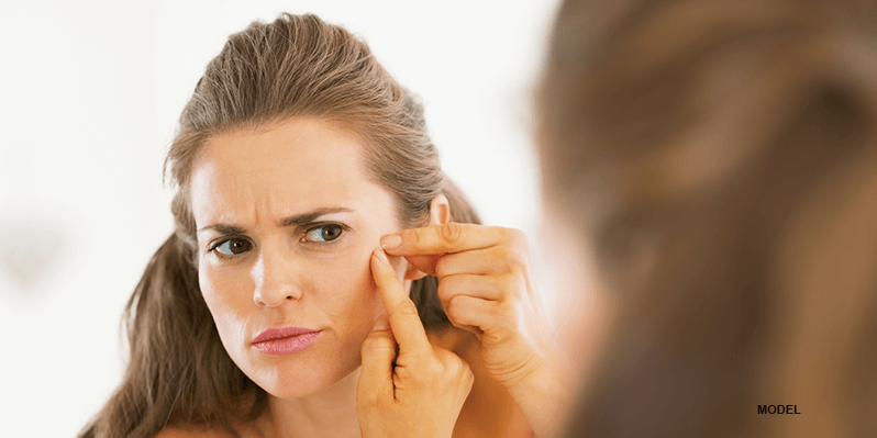woman acne scar